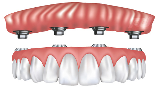 Ball Retained Dentures in San Francisco, CA